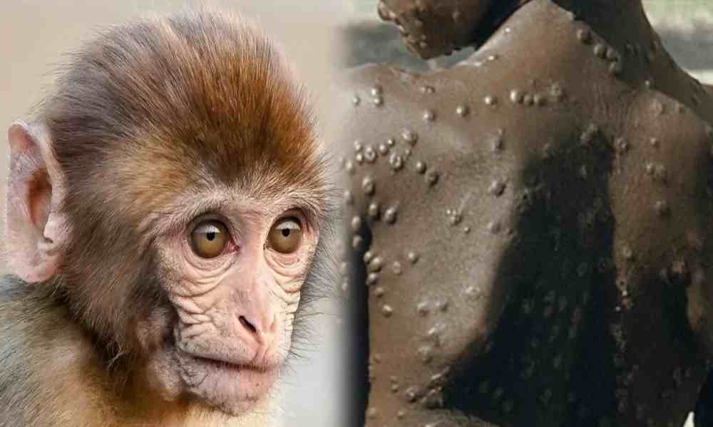 OMS: viruela del simio «emergencia mundial» y relacionada con homosexualidad