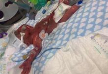 Bebé milagro nacido con 23 semanas de gestación cumple tres años